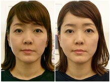 ア ニュームーン 明石ビブレ店(a New Moon)/小顔矯正ビフォーアフター