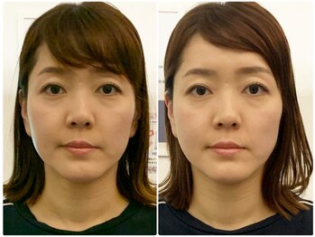 ア ニュームーン 明石ビブレ店(a New Moon)/小顔矯正ビフォーアフター