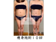 アイ エステサロン(Ai)/【40代】上半身だけ痩身施術♪