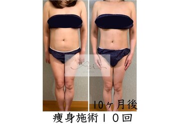 アイ エステサロン(Ai)/【40代】上半身だけ痩身施術♪