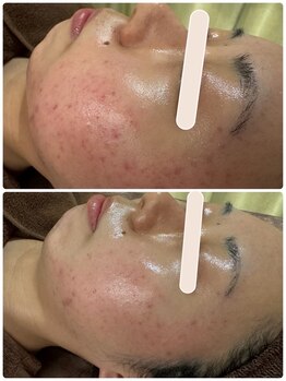 スキニティ(Skinity)/ハーブピーリング2回目