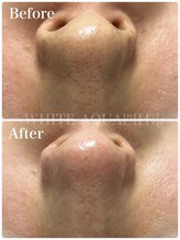 ホワイトアクア 四日市店(WHITE AQUA)/ハイドラ毛穴洗浄/毛穴改善