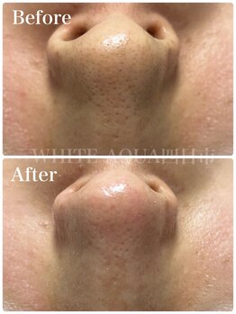 ホワイトアクア 四日市店(WHITE AQUA)/毛穴洗浄/毛穴改善