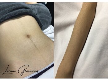 ラリマ グラマラス(Larima Glamorous)/全身毛穴レス脱毛