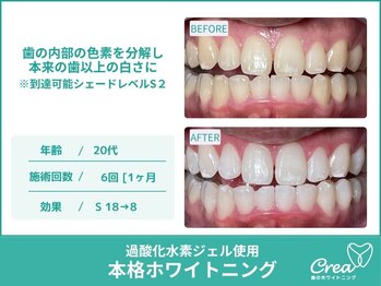 クレア(Crea)/【ホワイトニング症例写真】