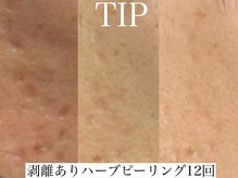 アリス(ALICE)/肌の凹凸にはハーブピーリング