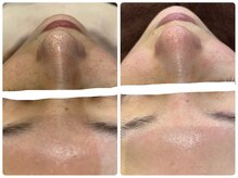 エルマナ(Hermana)/毛穴ケアビフォーアフター