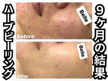 ベル 心斎橋店(Belle)/ハーブピーリング