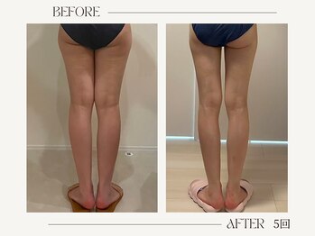 シーアンル(C.aneL)/施術ビフォーアフター 5回