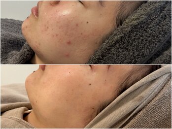 ピブ(PIBU)/ニキビ症例/ハーブピーリング