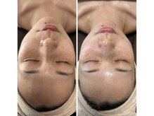 エタビー(etebe)/毛穴洗浄