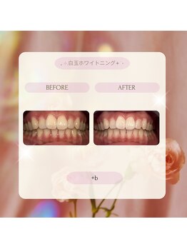 プラスビーセルフ(+b self)/ホワイトニングビフォーアフター