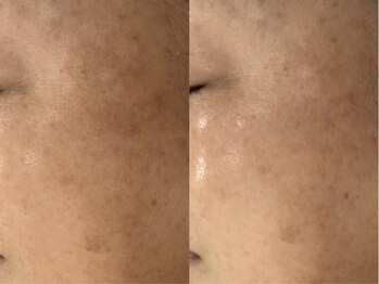 リシア(RECIA)/全体的なシミもここまで薄く☆