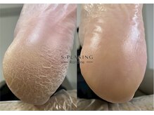 ロンディネ(Rondine)/足裏角質ケア