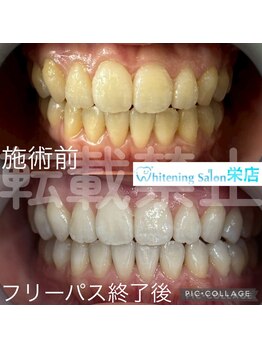 ホワイトニングサロン 名古屋 栄店/【ホワイトニング】