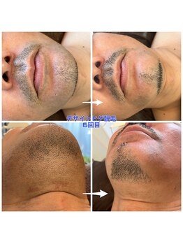 スパッツィオ(spazio)/【ヒゲ脱毛】6回 40代前半男性