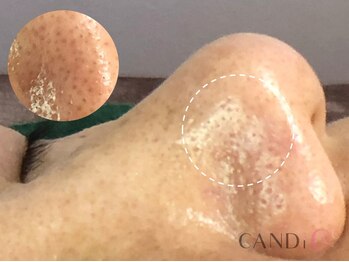 キャンディ 大阪梅田店(CANDi)/ハイドラピーリング/黒ずみ毛穴