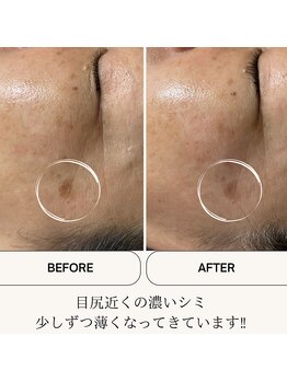 ランプシー(Lampsi)/臍帯血エステ