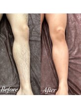 ボス 桑名店(BOSS)/足脱毛【before after】#脱毛
