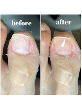 アネラネイル(anela nail)/巻き爪矯正