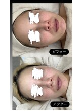 メリアミーゴ(Meli amigo)/20代　ハーブピーリング