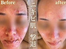 エレ(ele)の雰囲気（選べるピーリングで、赤みを落ち着かせ揺らぎ肌に徹底対策！）