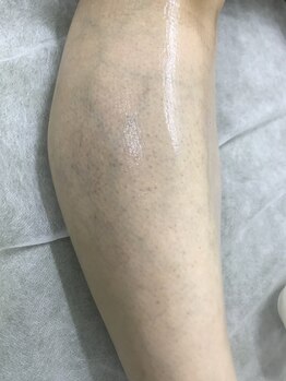 ナノハナ/鹿沼市の全身脱毛美容室ナノハナ