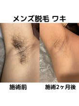 ビューティーラウンジ 自由が丘(BeautyLounge)/メンズ・ワキ脱毛人気★