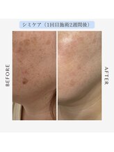 ジール(GIILL)/シミケアビフォーアフター