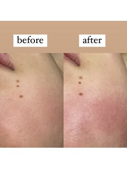 テンパ ビューティー(+10%beauty)/一撃タマゴ肌ワックス