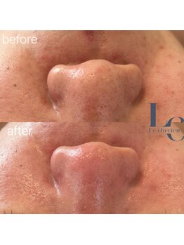 ルシェリア(Le cherien)/毛穴ケア！ハーブピーリング