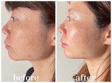 ルー ハナレ 神戸岡本 摂津本山店(Luu HANARE)/フェイスライン小顔　３回