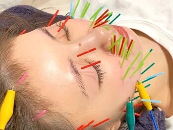 成城ていくけあ鍼灸整骨院の写真/モデルさん多数ご来店★本格美容鍼でリフトアップ・ほうれい線・たるみにお悩みの方に◎駅近で通いやすい♪