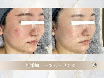 キレイ美肌 北心斎橋店/無添加ハーブピーリング