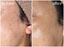 ホワイトアクア 天王寺本店(WHITE AQUA)/ララピールでニキビケア/天王寺