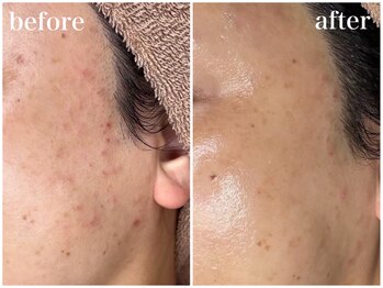 ホワイトアクア 天王寺本店(WHITE AQUA)/ララピールでニキビケア/天王寺