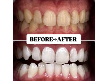 ホワイトニングサロン 豊中/Before&After美白ホワイトニング