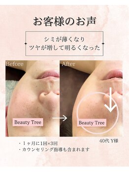 ビューティーツリー(Beauty Tree)/シミシワ改善！