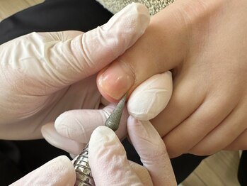 巻き爪ケア【STEP4】