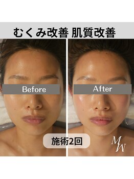 ミピマム/小顔コルギ