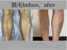 リル シャイン(Rill SHINE)/メンズ足脱毛