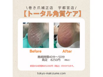 巻き爪補正店 宇都宮店