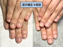 アリエ(allie)/やってよかった。深爪矯正