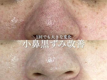 ルアナアイナ 大分/ハーブピーリング(2)