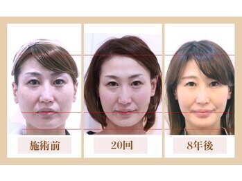 ビキュール 表参道店(美cuol)/8年経っても進化し続ける小顔術