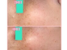 ララン(Laran)/ハイドラ&フォト