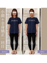 キアラ(chiara)/小顔＋全身矯正1回目(正面)