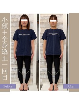 キアラ(chiara)/小顔＋全身矯正1回目(正面)