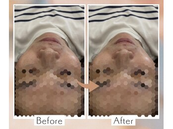 くすの木 治療院/口元が…フェイスラインが…