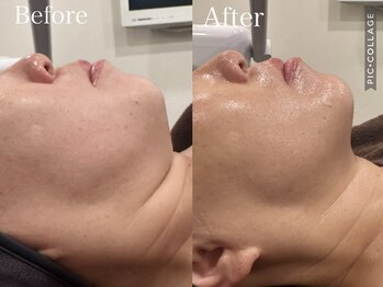 ウォーム(Warm)/フラクショナル施術例　40代